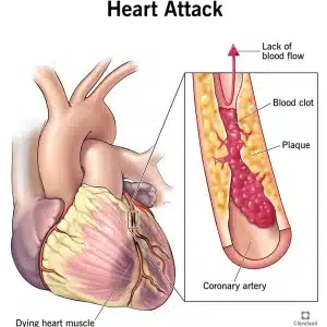 حمله قلبی یا سکته قلبی چیست؟